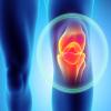 The Value of Joint Replacement for Patients with Osteoarthritis The Value of Joint Replacement for Patients with Osteoarthritis
