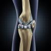The Value of Joint Replacement in Treating Patients with Osteoarthritis The Value of Joint Replacement in Treating Patients with Osteoarthritis
